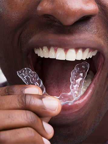 invisalign videos